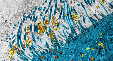 Épithélium nasal infecté par le SARS-COV-2