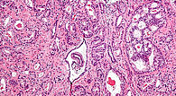 Cette image prise au microscope montre des cellules cancéreuses dans une coupe de la prostate.