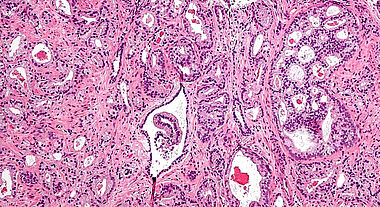Cette image prise au microscope montre des cellules cancéreuses dans une coupe de la prostate.