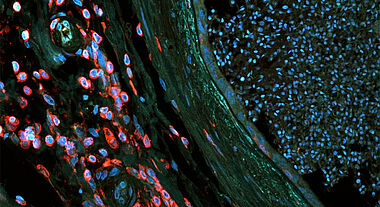 Cette coupe transversale de l’épididyme d’un sujet vasectomisé montre, à droite, en bleu, un grand nombre de spermatozoïdes. À gauche, en rouge, on observe des leucocytes CD45+ en abondance. Ces cellules du système immunitaire sont rares dans l’épididyme des sujets non vasectomisés.